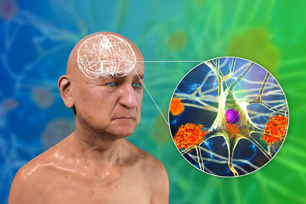New Study Challenges Decades of Alzheimer’s Understanding With ...
