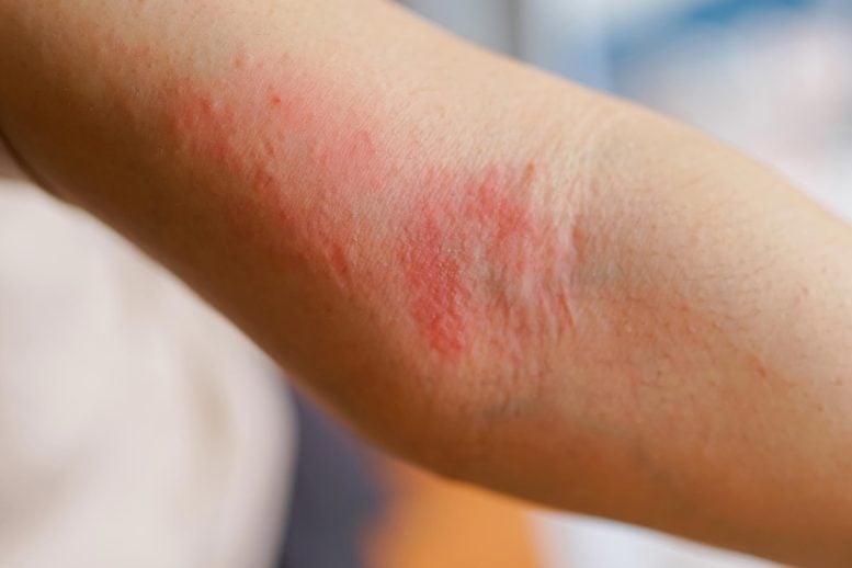 It’s Not Just in Your Head: Stress May Directly Worsen Eczema