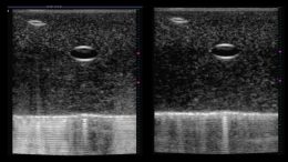 Sharper Ultrasound Images Improved Diagnostics