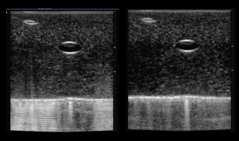 Sharper Ultrasound Images Improved Diagnostics