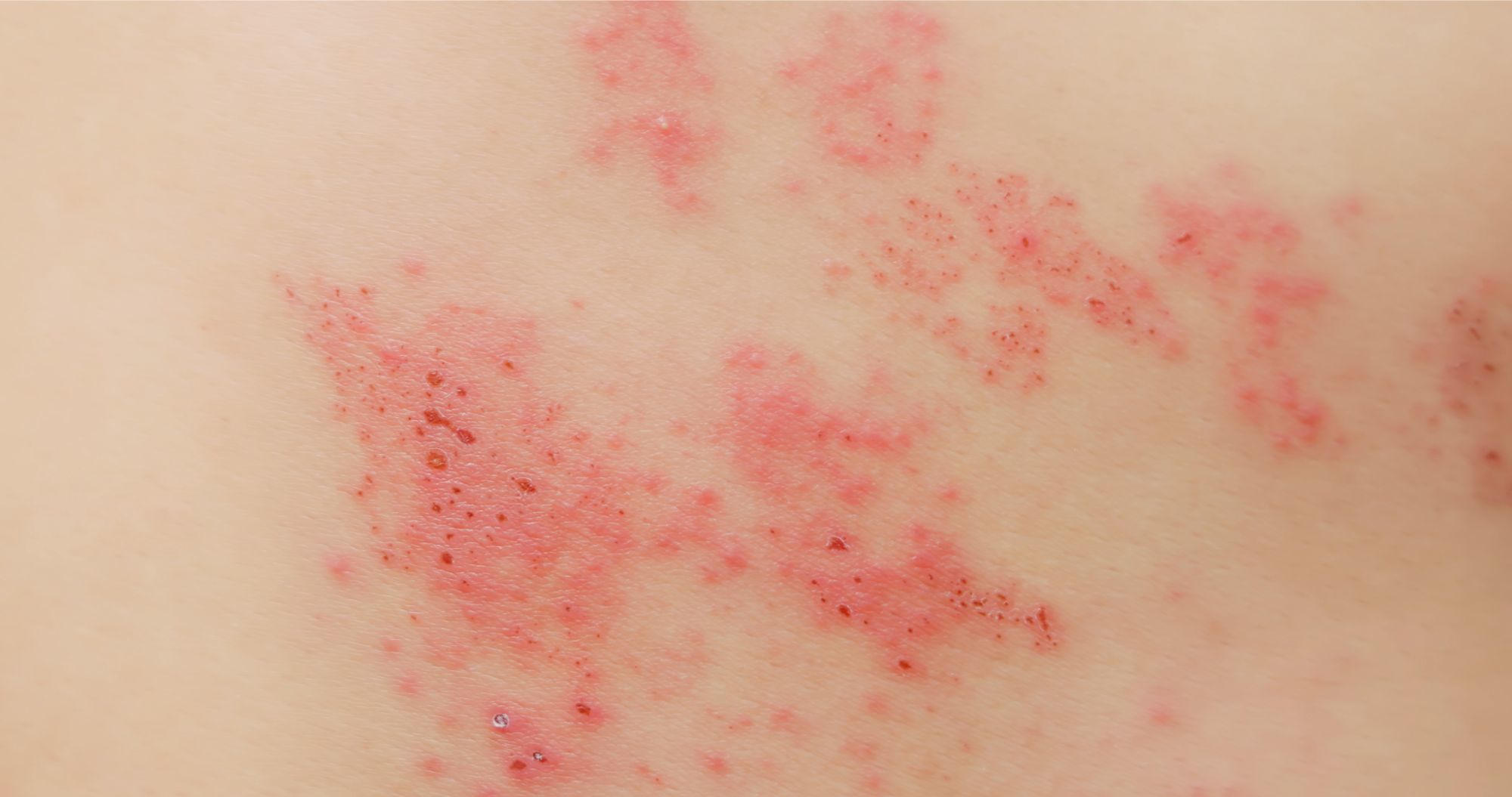 How To Clear A Shingles Rash At Julian Lentini Blog How To Clear A Shingles Rash At Julian Lentini Blog