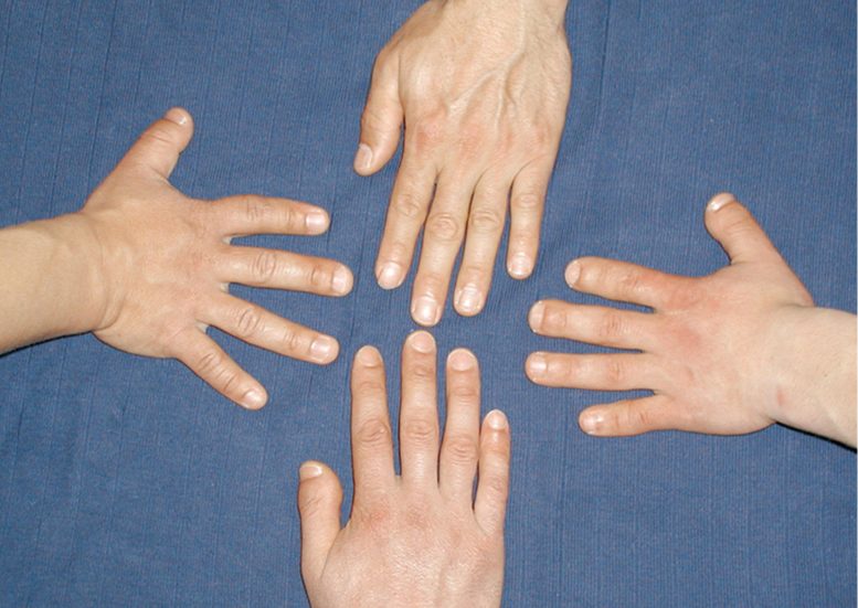 Short Fingers Hypertension Family