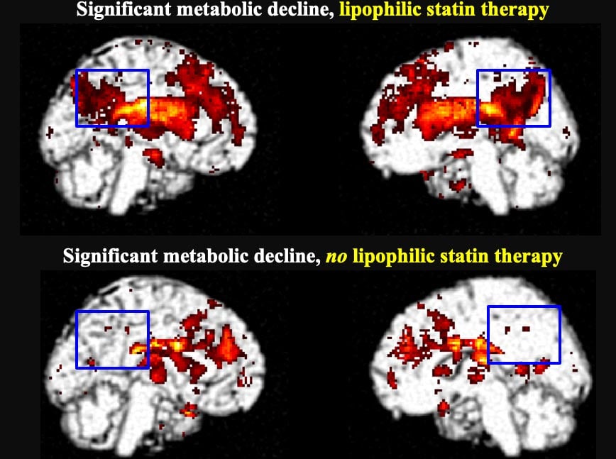 Significant metabolic decline in the posterior cingulate cortex in lipophilic statin users after five to six years (top) compared to hydrophilic stati