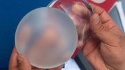 Silicone Breast Implant Surfaces