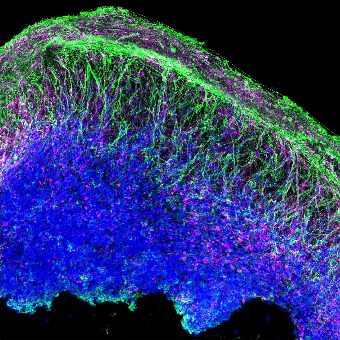 New Window Into Autism From Brain-Like Organoids Grown in a Dish