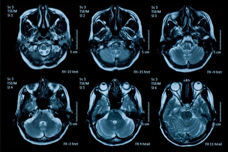 Six Top Brain Scan MRI Images