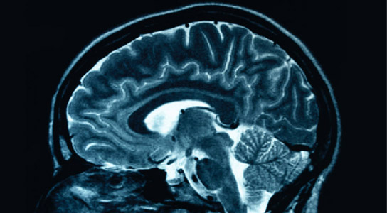 Size Does Matter When Determining Alzheimer's Risk