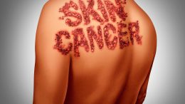 Skin Cancer Melanoma Concept Illustration