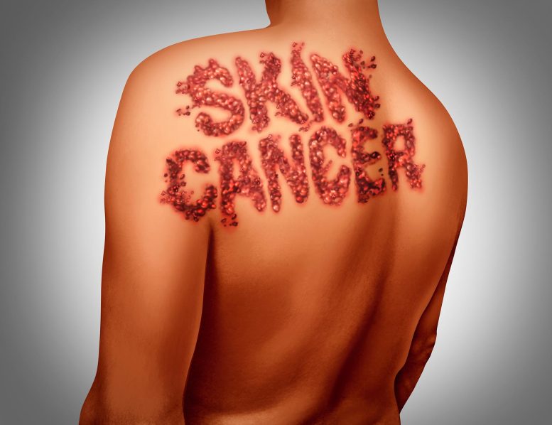 Skin Cancer Melanoma Concept Illustration