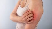 Skin Disease Arm Woman