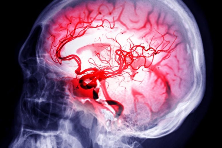 Skull Image Fusion MRI MRA Brain Stenosis Stroke Disease
