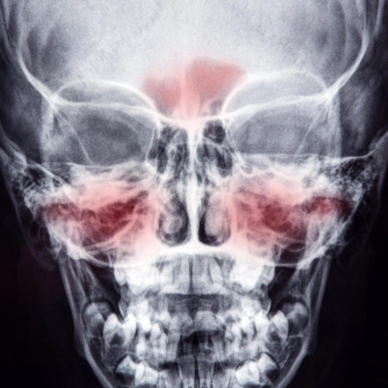 Skull X-ray Sinusitis Inflammation Sinuses
