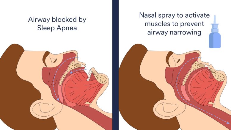 Sleep Apnea Nasal Spray