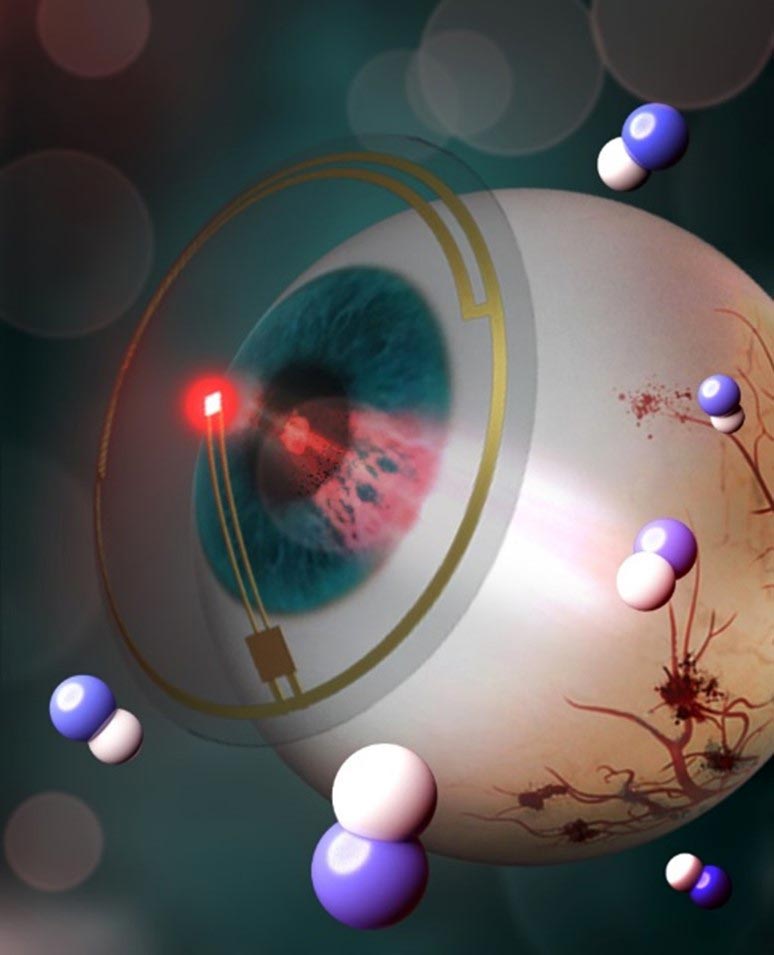 Smart LED Contact Lenses for Treating Diabetic Retinopathy