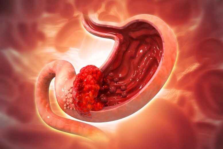 Scientists Find a Possible Way To Interrupt Stomach Cancer Before It Begins
