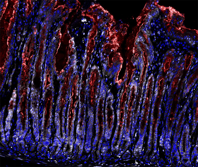 Stomach Tissue Infected With Helicobacter pylori