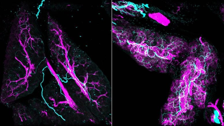 Pancreatic Cancer Grows by Recruiting the Body’s Nerves