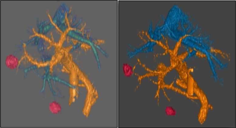 Targeted New Approach to Treat Pancreatic Cancer