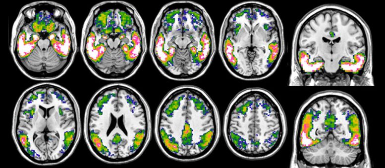 Tau Imaging With 18F Flortaucipir PET in Alzheimer’s Disease