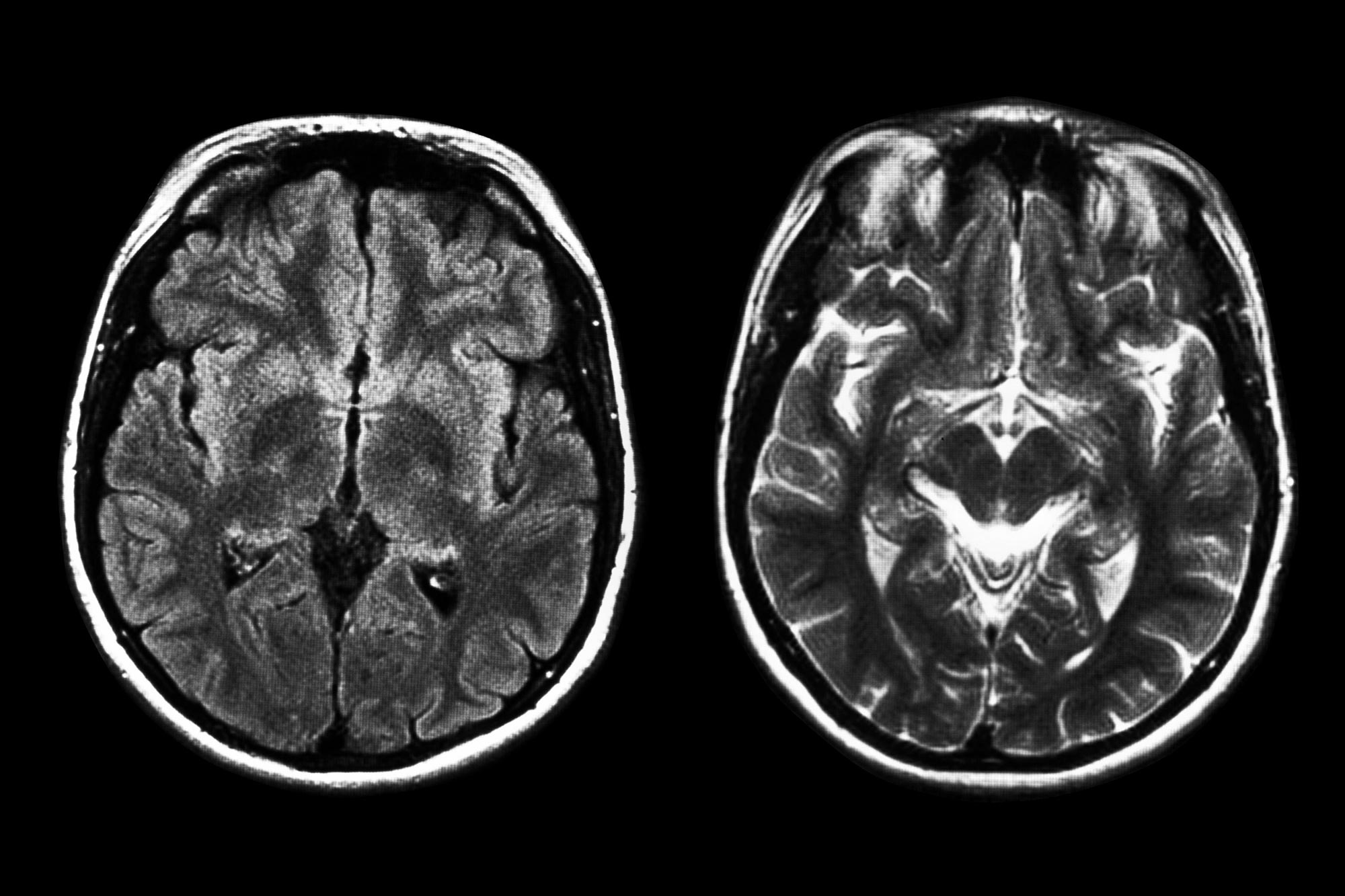Le migliori immagini MRI di scansione del cervello
