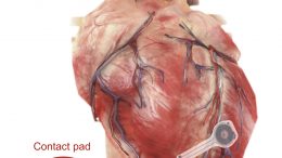 Transient Pacemaker Mounted on Myocardial Tissue