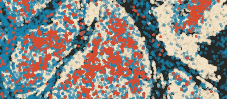 Tumor Containing Infiltrating Neutrophils