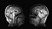 Two Brain MRI Scan