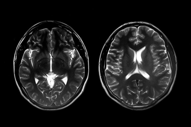 Two Brain Scans