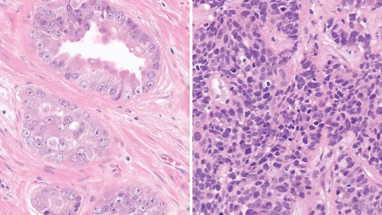 Typical Glandular Prostate Adenocarcinoma and Prostate Cancer With Transdifferentiation