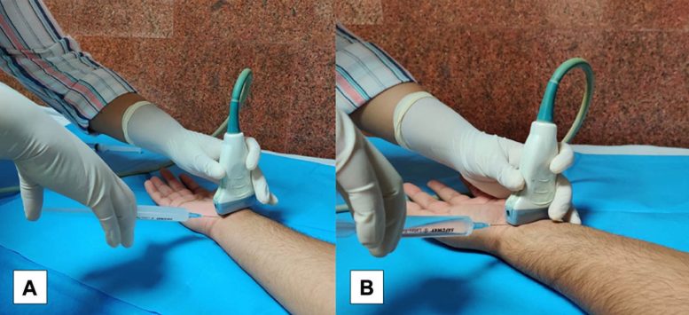 Ultrasound Guided Hydrodissection for Carpal Tunnel Syndrome