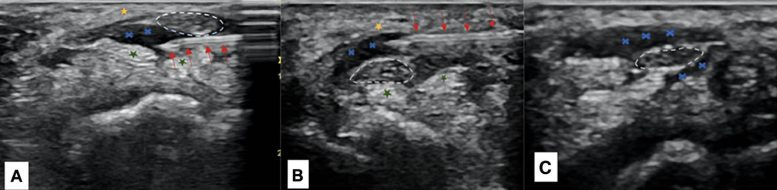 Ultrasound Images of Median Nerve Hydrodissection