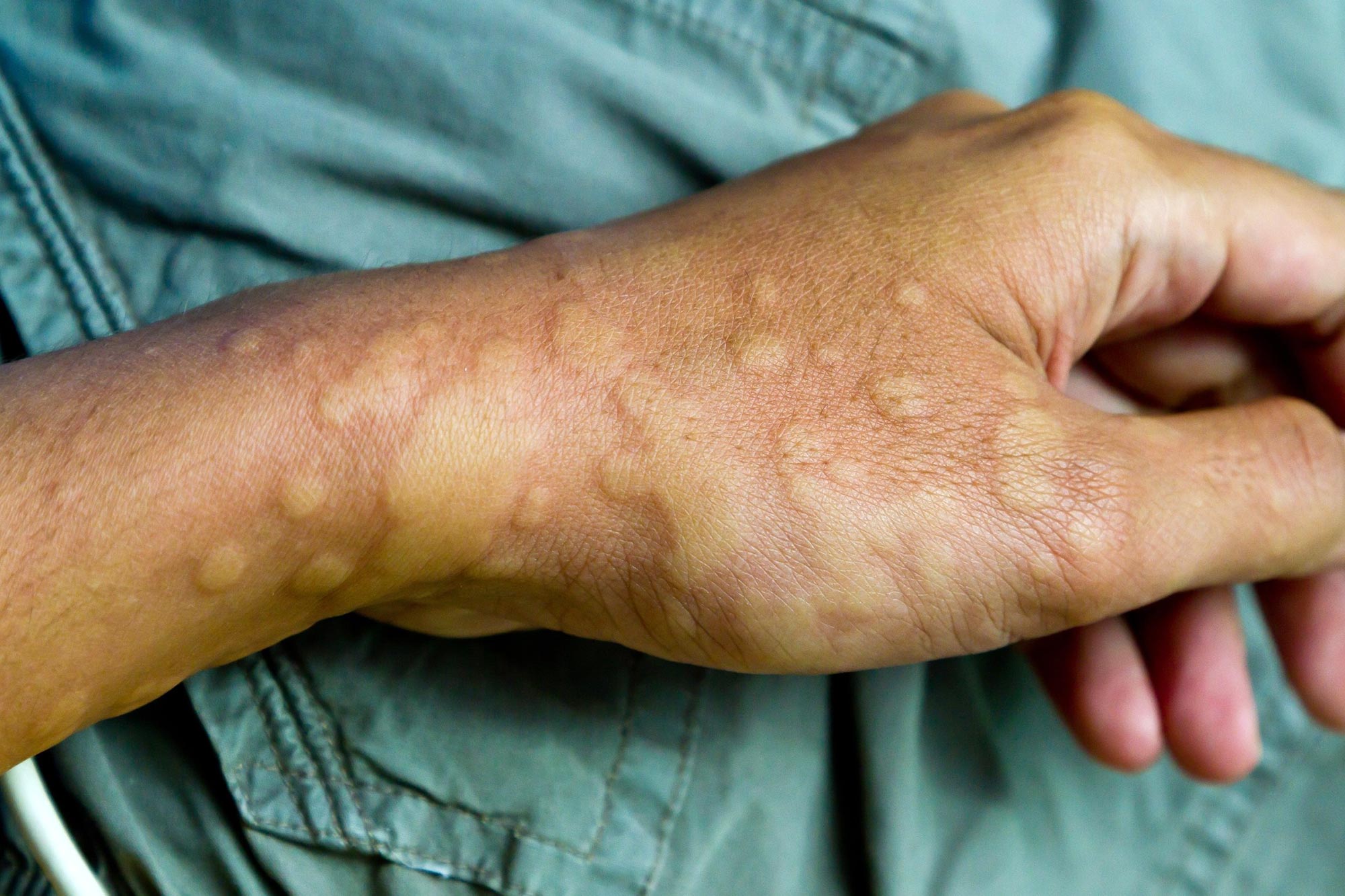 vaccination urticaria recur reassurance concerns scitechdaily