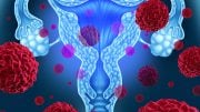 Uterine Endometrial Cancer Therapy Concept
