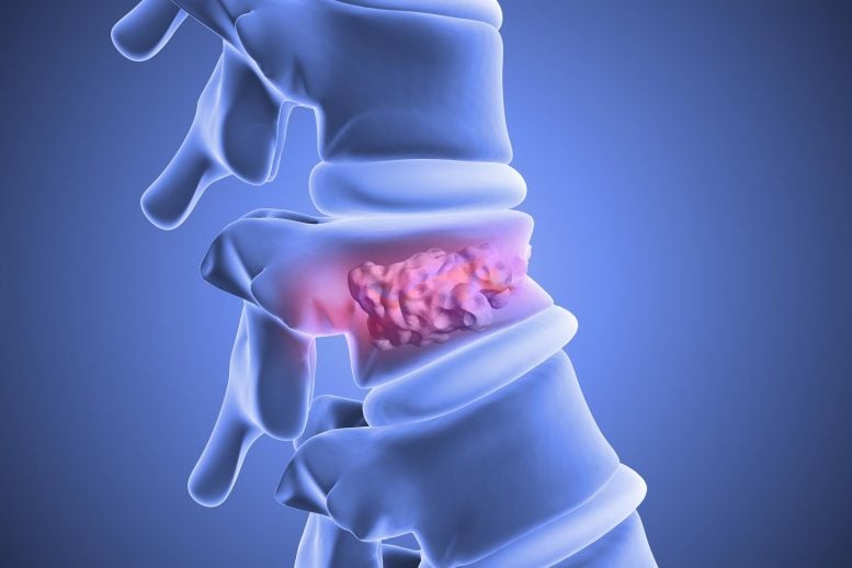 Fat Stem Cells Heal Broken Spines in a Breakthrough Study