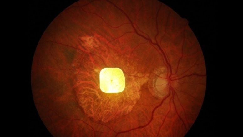 Solar-Powered Eye Implant Restores Reading Vision