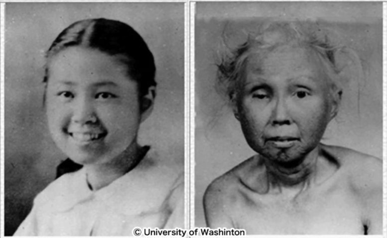 Werner Syndrome Accelerated Aging