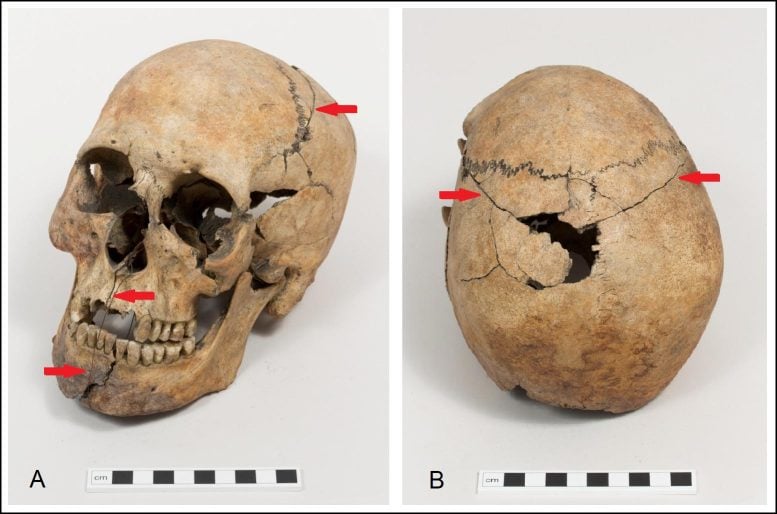 Westminster Abbey Skull Repaired in 1869