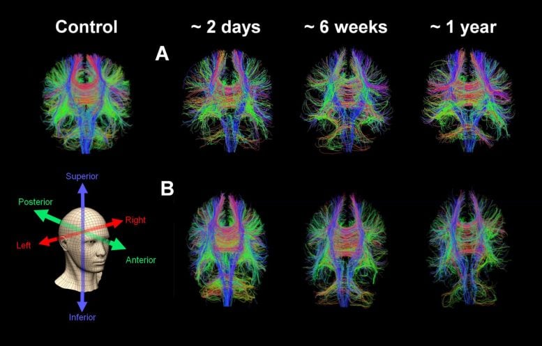 Whole Brain Diffusion Tensor Tractography