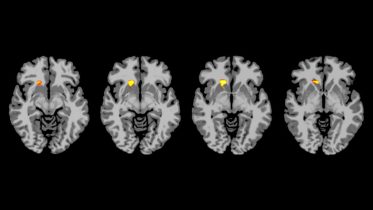 Why Some Type 1 Diabetics Miss Low Blood Sugar Cues