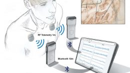 Wireless Recording of Brain Activity