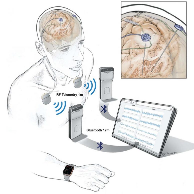 Wireless Recording of Brain Activity