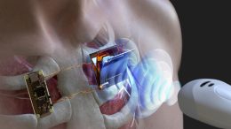 Wirelessly Charging Body Implanted Electronic Device