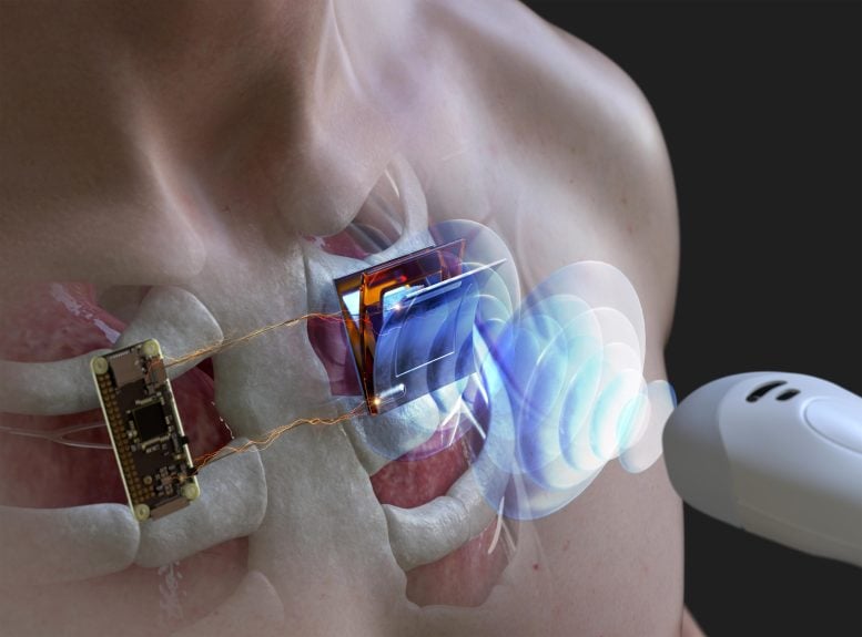 Wirelessly Charging Body Implanted Electronic Device