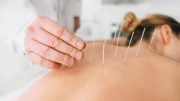Woman Acupuncture Back