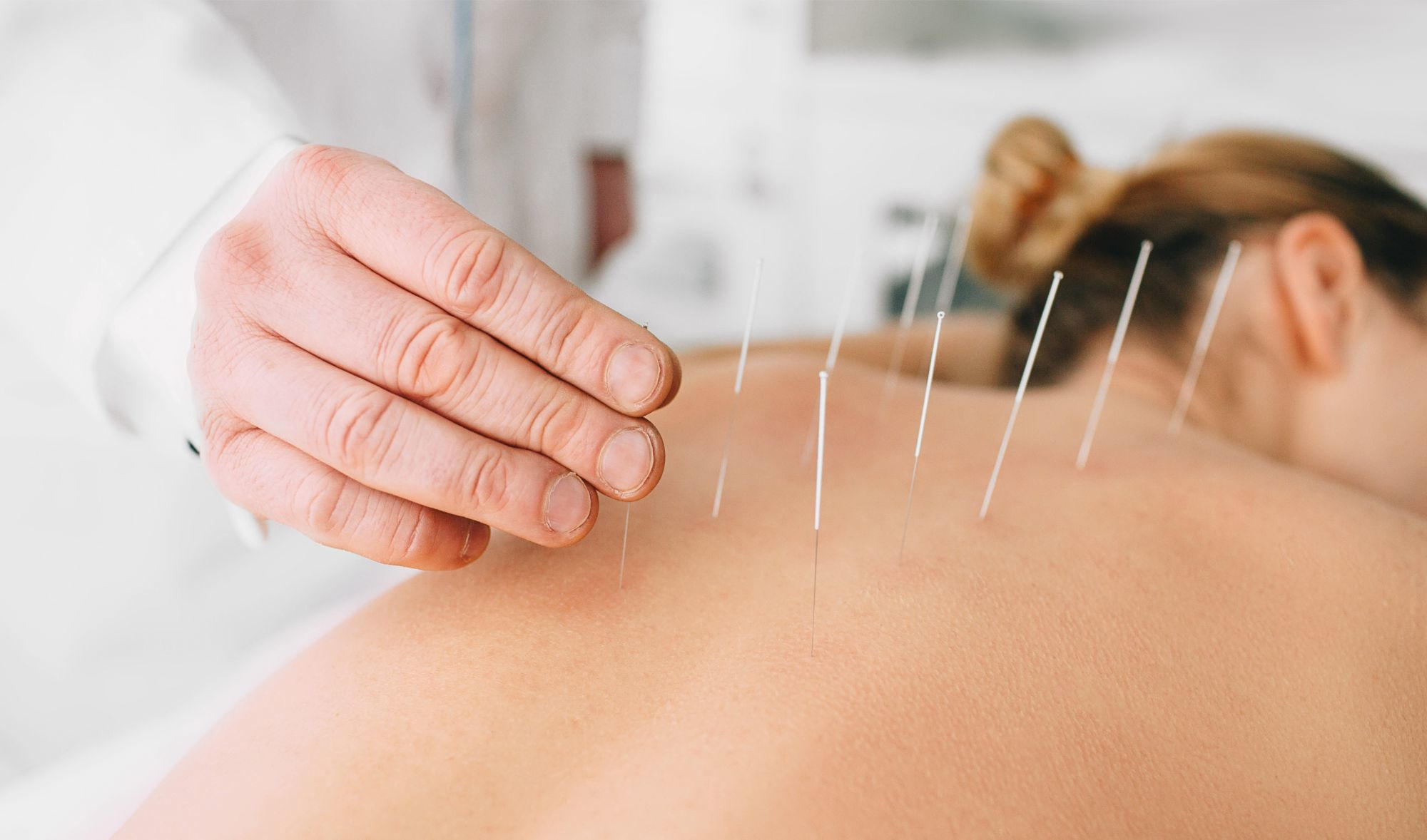 Woman Acupuncture Back