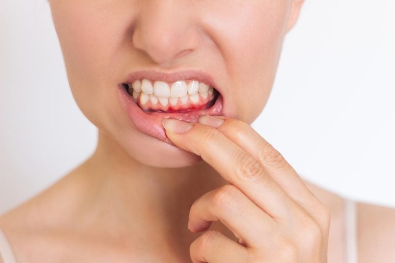 Woman Inflammation Lower Gum Disease