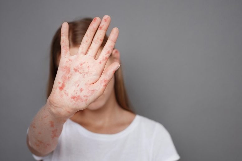 Woman Stop Measles Disease Spread
