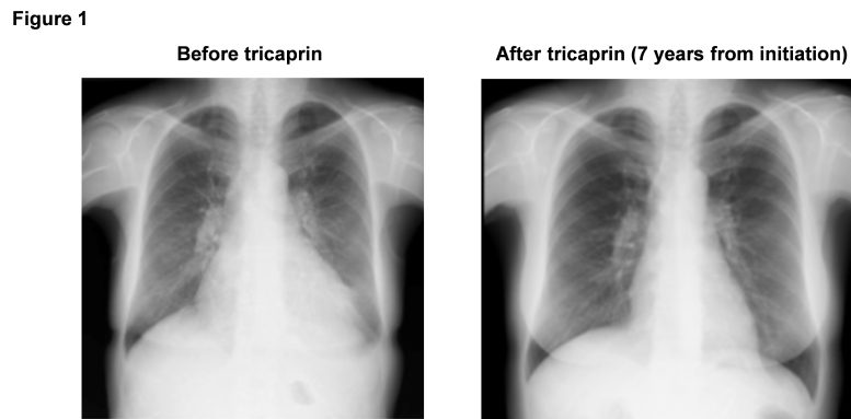 X Ray Showing the Effects of Tricaprin Treatment