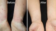 Yale Researchers Successfully Treat Eczema with Arthritis Drug