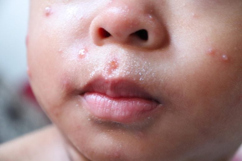 Young Child Face Measles